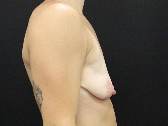 Breast Lift/Breast Lift Augmentation: Case 54 - Before