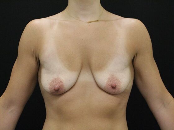 Breast Lift/Breast Lift Augmentation Case 54 - Before
