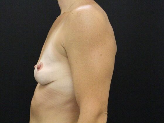 Breast Lift/Breast Lift Augmentation: Case 54 - After