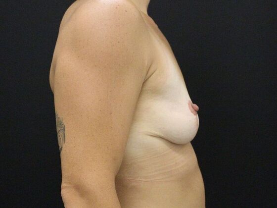 Breast Lift/Breast Lift Augmentation: Case 54 - After