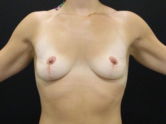 Breast Lift/Breast Lift Augmentation Case 54 - After