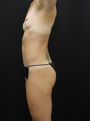 Tummy Tuck: Case 67 - After