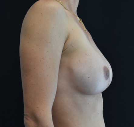 Breast Augmentation: Case 17 - Before