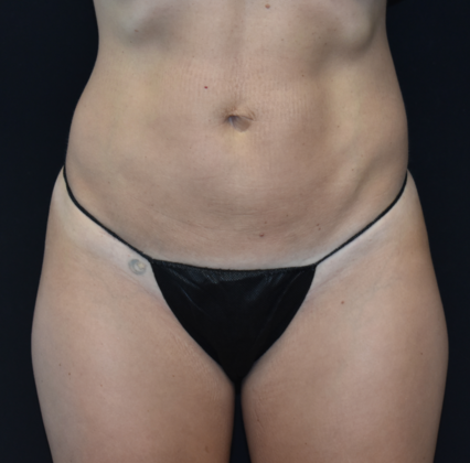 Abdominoplasty Case 15 - Before