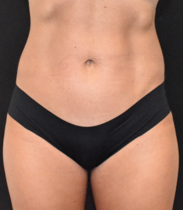 Abdominoplasty Case 15 - After