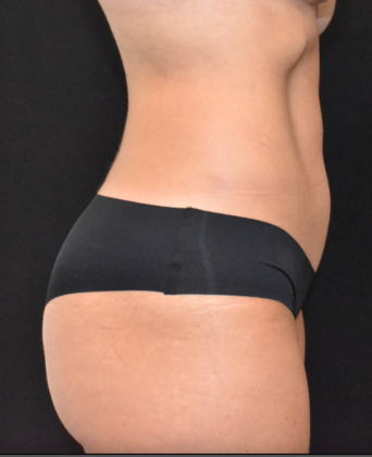 Abdominoplasty: Case 15 - After
