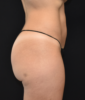 Abdominoplasty: Case 15 - Before