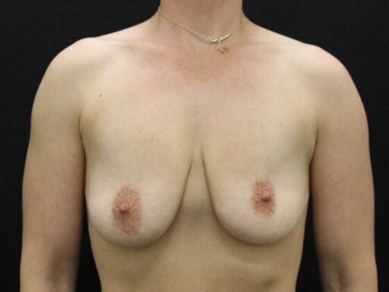 Breast Lift/Breast Lift Augmentation Case 55 - Before