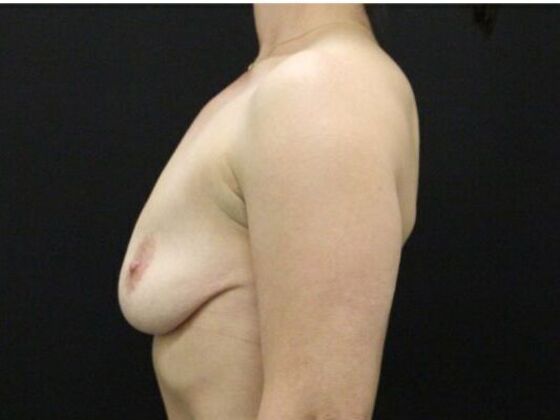 Breast Lift/Breast Lift Augmentation: Case 55 - Before