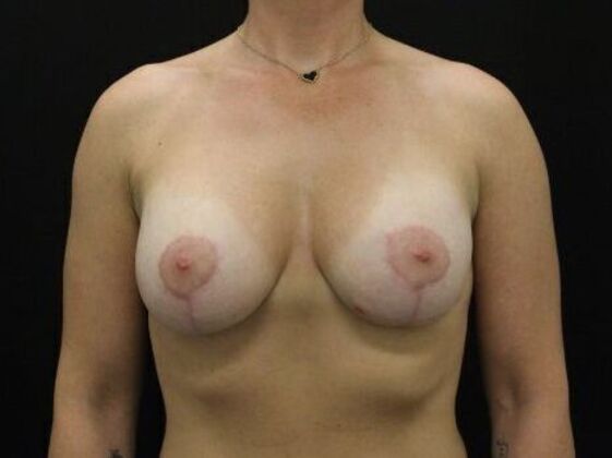 Breast Lift/Breast Lift Augmentation Case 55 - After