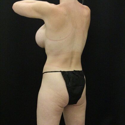 Tummy Tuck: Case 68 - After