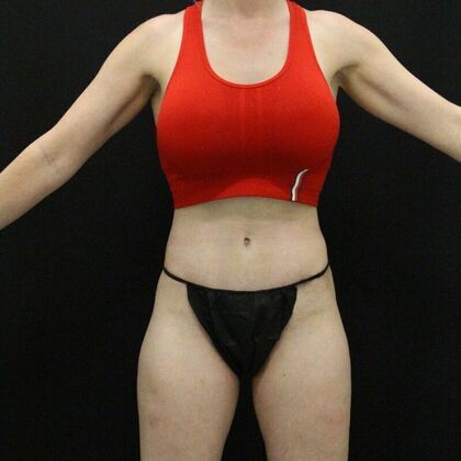 Tummy Tuck Case 68 - After