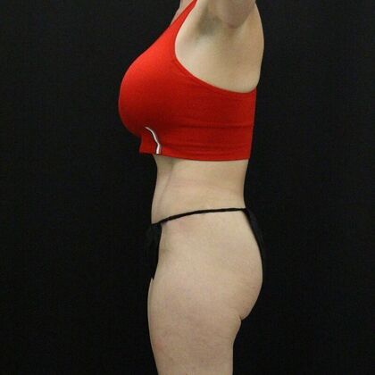 Tummy Tuck: Case 68 - After