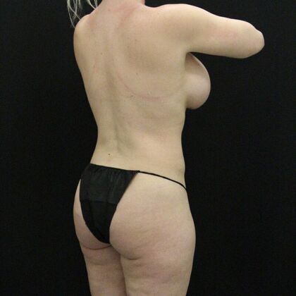 Tummy Tuck: Case 68 - Before