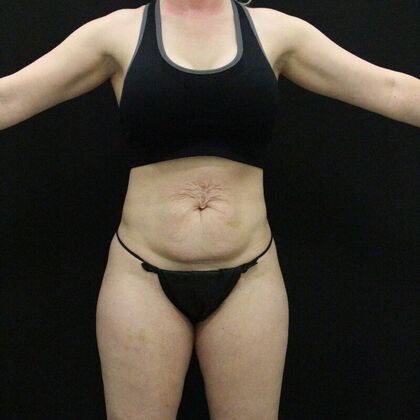 Tummy Tuck Case 68 - Before