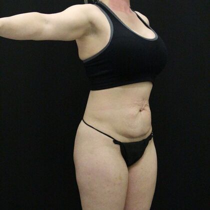 Tummy Tuck: Case 68 - Before