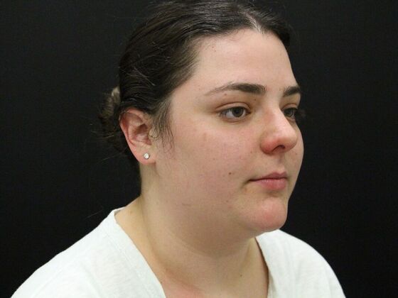 Face & Neck Lifts: Case 42 - Before