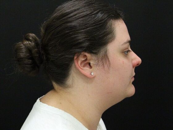 Face & Neck Lifts Case 42 - Before