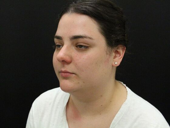 Face & Neck Lifts: Case 42 - Before