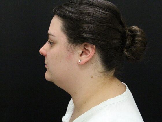 Face & Neck Lifts: Case 42 - Before