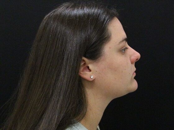 Face & Neck Lifts Case 42 - After