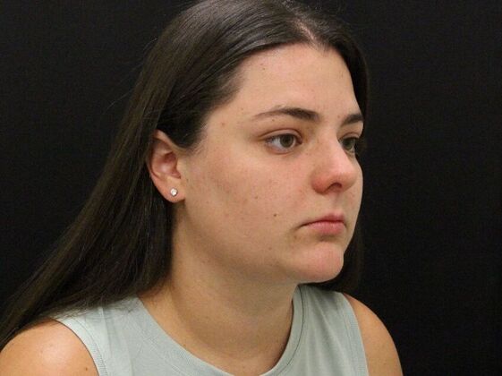 Face & Neck Lifts: Case 42 - After