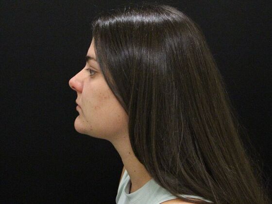 Face & Neck Lifts: Case 42 - After