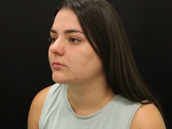 Face & Neck Lifts: Case 42 - After