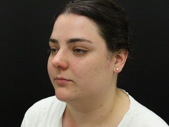 Liposuction: Case 30 - Before