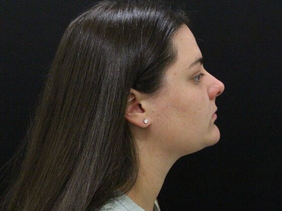 Liposuction: Case 30 - After