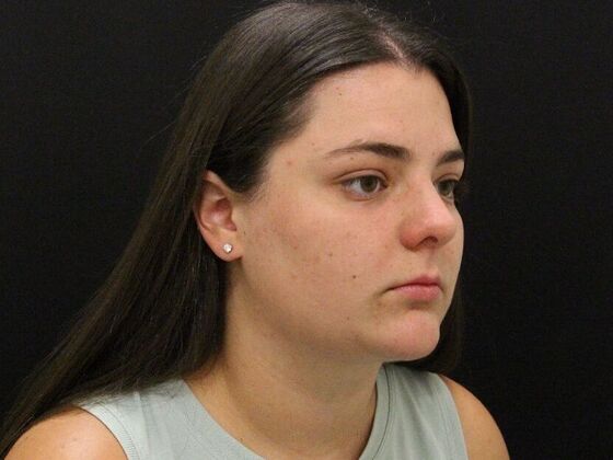 Liposuction: Case 30 - After