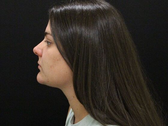 Liposuction Case 30 - After