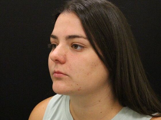 Liposuction: Case 30 - After