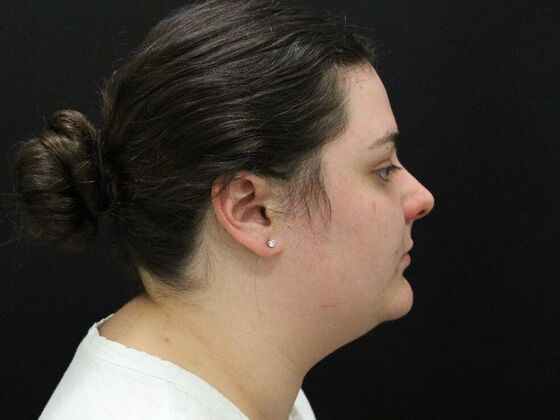 Liposuction: Case 30 - Before