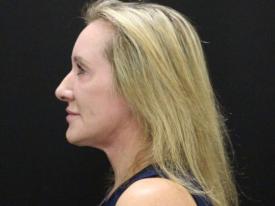 Face & Neck Lifts Case 43 - After