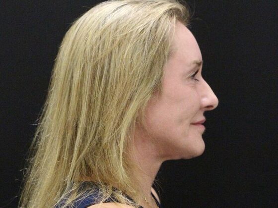 Face & Neck Lifts: Case 43 - After