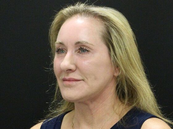 Face & Neck Lifts: Case 43 - After