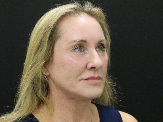 Face & Neck Lifts: Case 43 - After