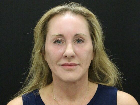 Face & Neck Lifts: Case 43 - After