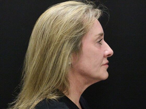 Face & Neck Lifts: Case 43 - Before