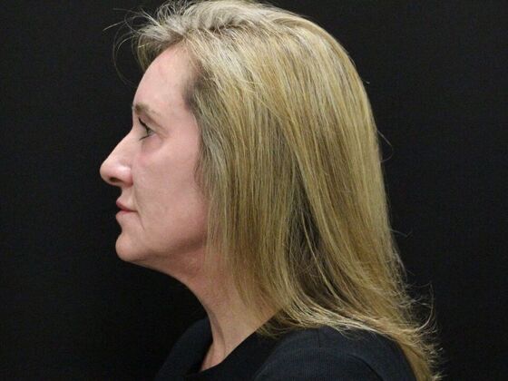 Face & Neck Lifts Case 43 - Before