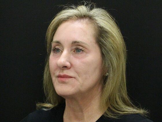 Face & Neck Lifts: Case 43 - Before