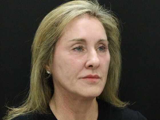 Face & Neck Lifts: Case 43 - Before