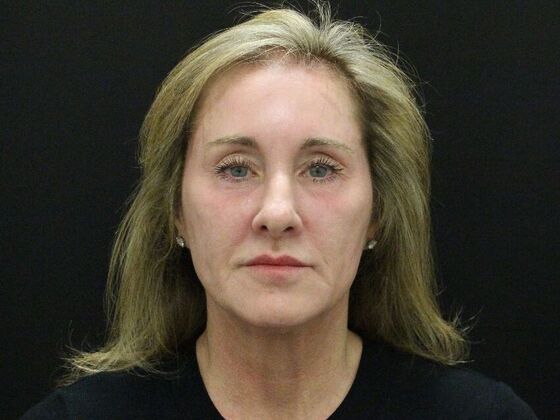 Face & Neck Lifts: Case 43 - Before