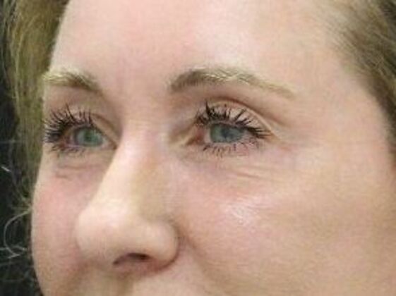 Non-Surgical: Case 9 - After