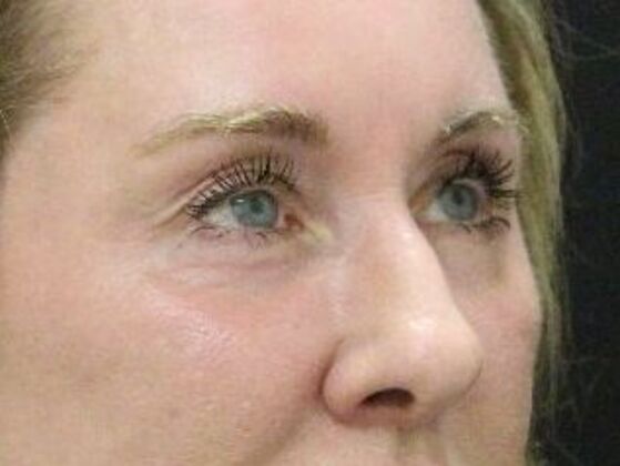 Non-Surgical: Case 9 - After