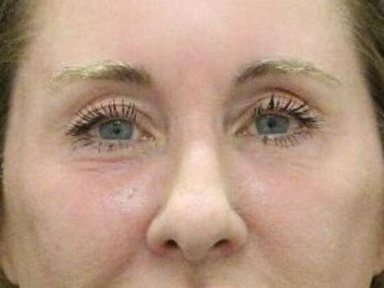 Non-Surgical: Case 9 - After