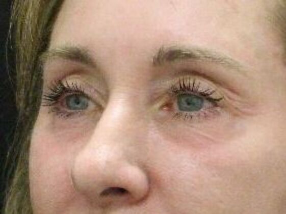 Non-Surgical: Case 9 - Before