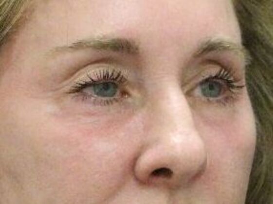 Non-Surgical: Case 9 - Before