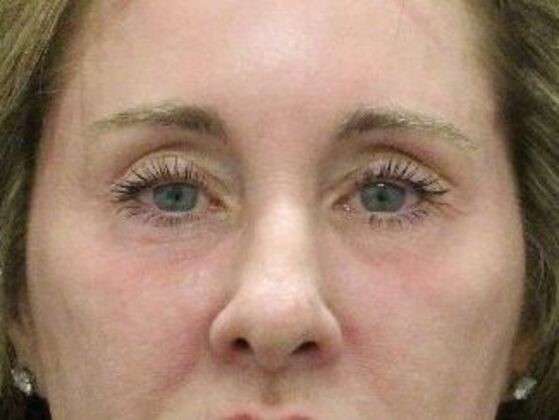 Non-Surgical: Case 9 - Before